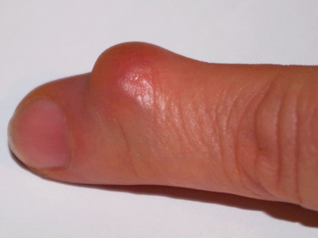 Thumb clit